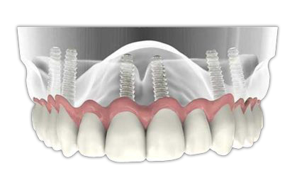 Illustration of an upper arch dental implant-supported full bridge attached to six dental implants in the jawbone