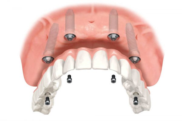 Illustration showing a full-arch denture being anchored to four dental implants that have been placed in a patient’s jaw