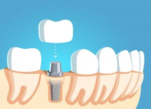 Dental implant illustration showing the removed crown
