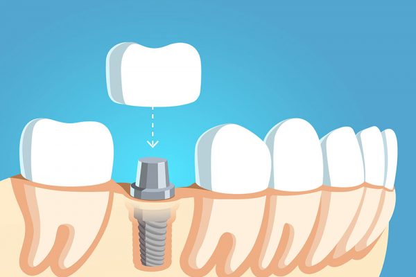Dental implant illustration showing the removed crown